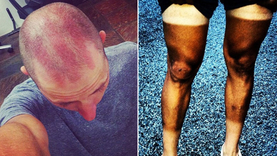 自行車(chē)愛(ài)好者自曝曬傷圖引圍觀(guān)【圖】