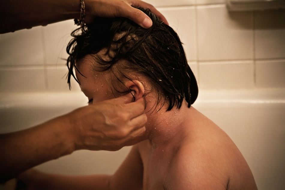 孤兒?。呼~鱗病女孩的艱難生活【圖】