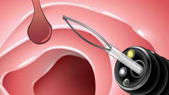 【健康解碼&middot;小貼士】檢查出息肉 需要切除嗎？